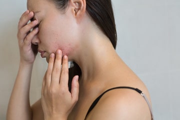 How does stress affect your skin and your body?