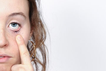 What causes eyelid cancer?