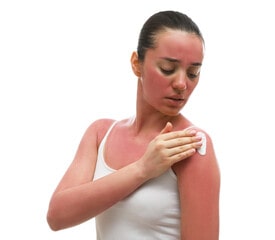 How to treat sunburn?