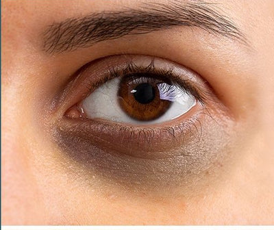 How to get rid of dark circles under the eyes?